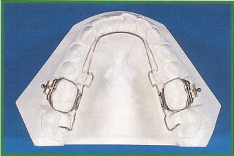 Arco linguale 3D